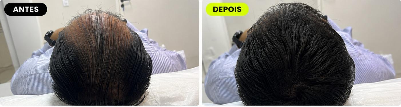 Antes e depois - Protocolo For Man