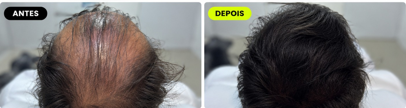 Antes e depois - Protocolo For Man